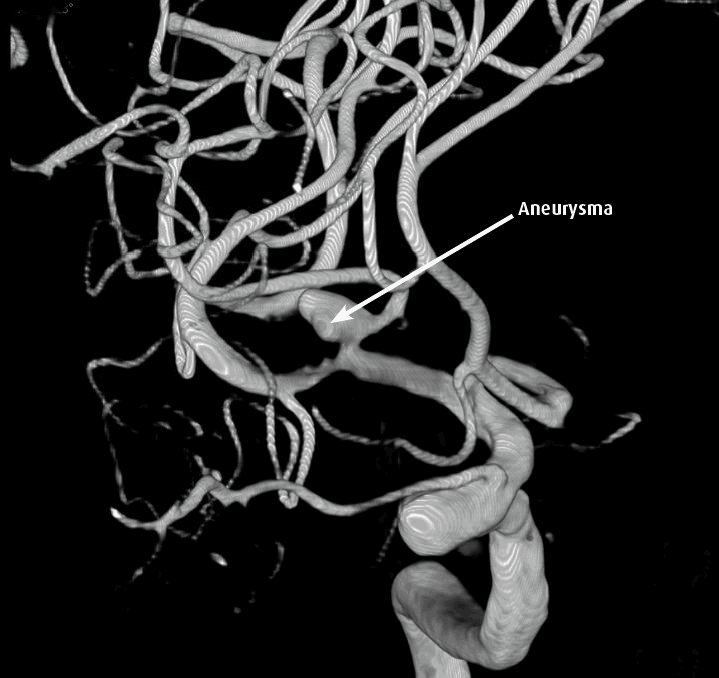 Patiëntenplatform Hersenaneurysma en SAB Wat is een angiografie?